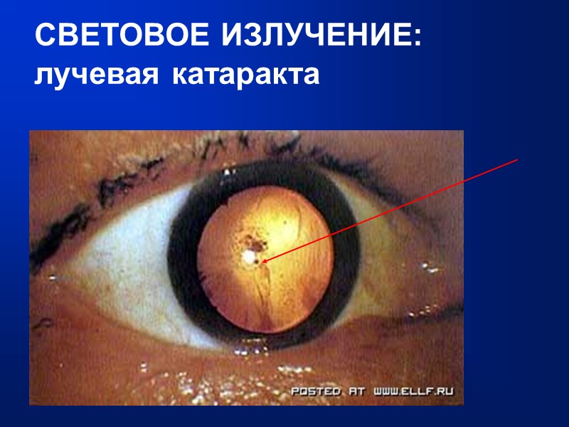 СВЕТОВОЕ ИЗЛУЧЕНИЕ: лучевая катаракта